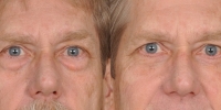 Lower Eyelid Lift Blepharoplasty Before and After Dr Edmon Khoury 100