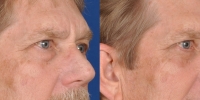 Lower Eyelid Lift Blepharoplasty Before and After Dr Edmon Khoury 101