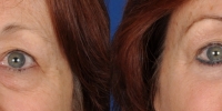 Lower Eyelid Lift Blepharoplasty Before and After Dr Edmon Khoury 102