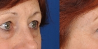 Lower Eyelid Lift Blepharoplasty Before and After Dr Edmon Khoury 103