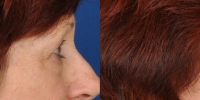 Lower Eyelid Lift Blepharoplasty Before and After Dr Edmon Khoury 104