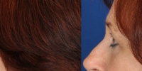 Lower Eyelid Lift Blepharoplasty Before and After Dr Edmon Khoury 105