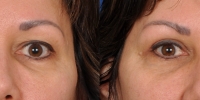 Upper Eyelid Lift Blepharoplasty Before and After Dr Edmon Khoury 100