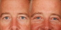 Upper Eyelid Lift Blepharoplasty Before and After Dr Edmon Khoury 102