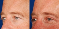 Upper Eyelid Lift Blepharoplasty Before and After Dr Edmon Khoury 103