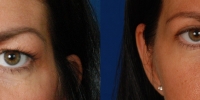 Upper Eyelid Lift Blepharoplasty Before and After Dr Edmon Khoury 104