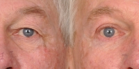 Upper and Lower Eyelid Lift  Blepharoplasty Before and After Dr Edmon Khoury 100