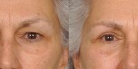 Upper and Lower Eyelid Lift Blepharoplasty Before and After Dr Edmon Khoury 102