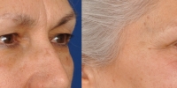 Upper and Lower Eyelid Lift  Blepharoplasty Before and After Dr Edmon Khoury 103