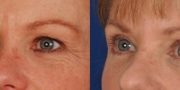 Upper and Lower Eyelid Lift  Blepharoplasty Before and After Dr Edmon Khoury 104