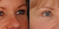 Upper and Lower Eyelid Lift  Blepharoplasty Before and After Dr Edmon Khoury 105