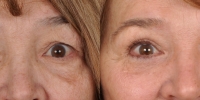 Upper and Lower Eyelid Lift  Blepharoplasty Before and After Dr Edmon Khoury 106