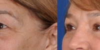 Upper and Lower Eyelid Lift  Blepharoplasty Before and After Dr Edmon Khoury 107