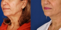 dr-khoury-facelifts-02