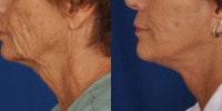 dr-khoury-facelifts-12