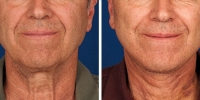 Laser Assisted Facelifts (SmartLifting) 05 / Before and after photo of a laser assisted full lower facelift with platysmaplasty – ONE WEEK LATER!