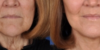 Lower Facelift Necklift Before and After Dr Edmon Khoury 100