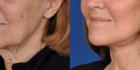 Lower Facelift Necklift Before and After Dr Edmon Khoury 101