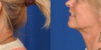 Lower Facelift Necklift Before and After Dr Edmon Khoury 103