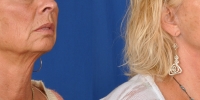 Lower Facelift Necklift Before and After Dr Edmon Khoury 105