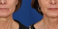Lower Facelift Necklift Before and After Dr Edmon Khoury 107