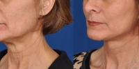 Lower Facelift Necklift Before and After Dr Edmon Khoury 108