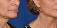 Lower Facelift Necklift Before and After Dr Edmon Khoury 109