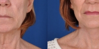 Lower Facelift Necklift Before and After Dr Edmon Khoury 112