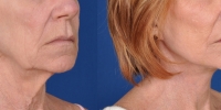 Lower Facelift Necklift Before and After Dr Edmon Khoury 114