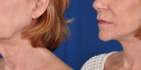 Lower Facelift Necklift Before and After Dr Edmon Khoury 115
