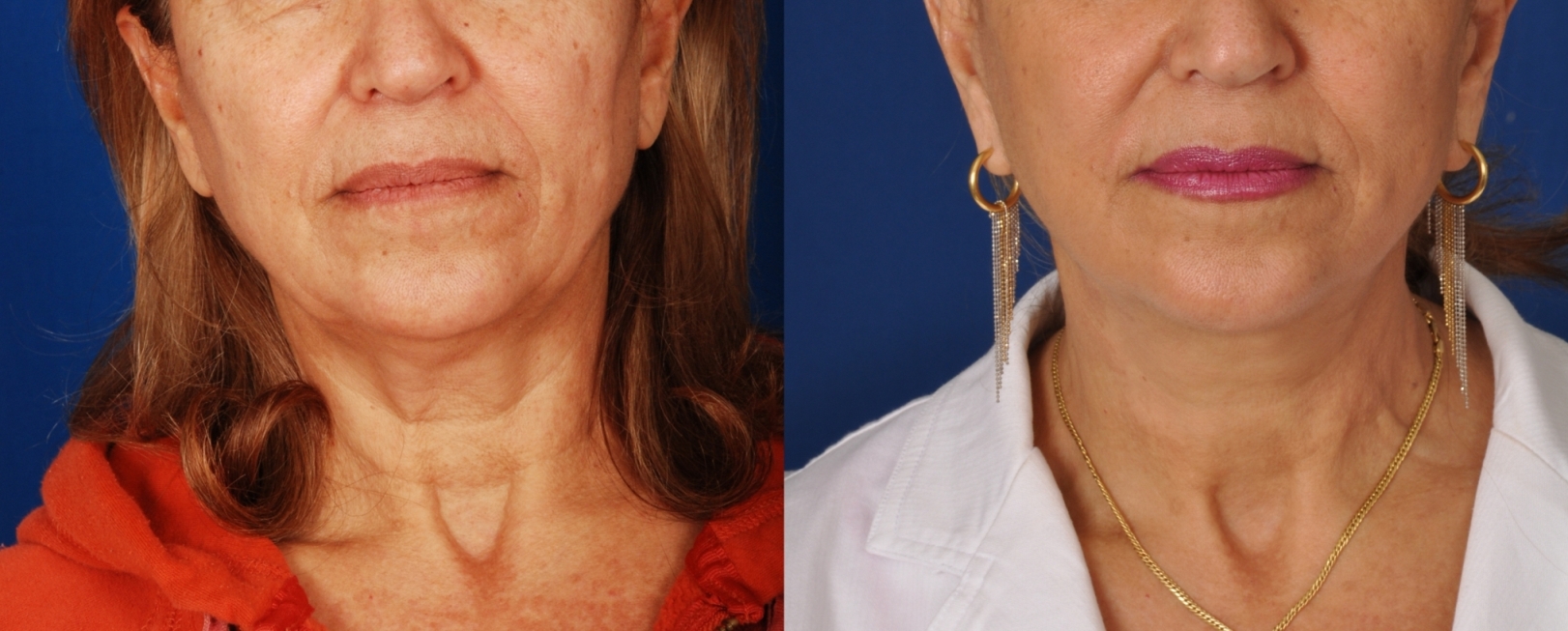 Facelift & Neck Lift in Denver, CO