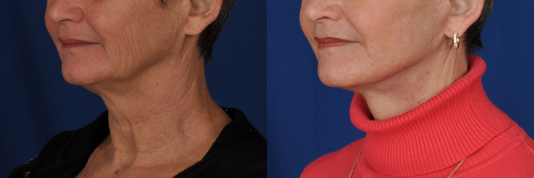 Face Lift - Patient Photo 3