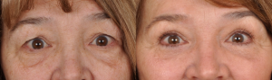 Eyelid Lift Before and After Photos