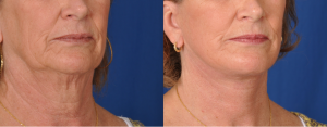 Facelift Before and After Photos