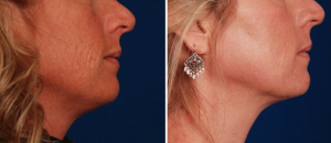 Laser Resurfacing to reverse sun damage by Dr. Khoury