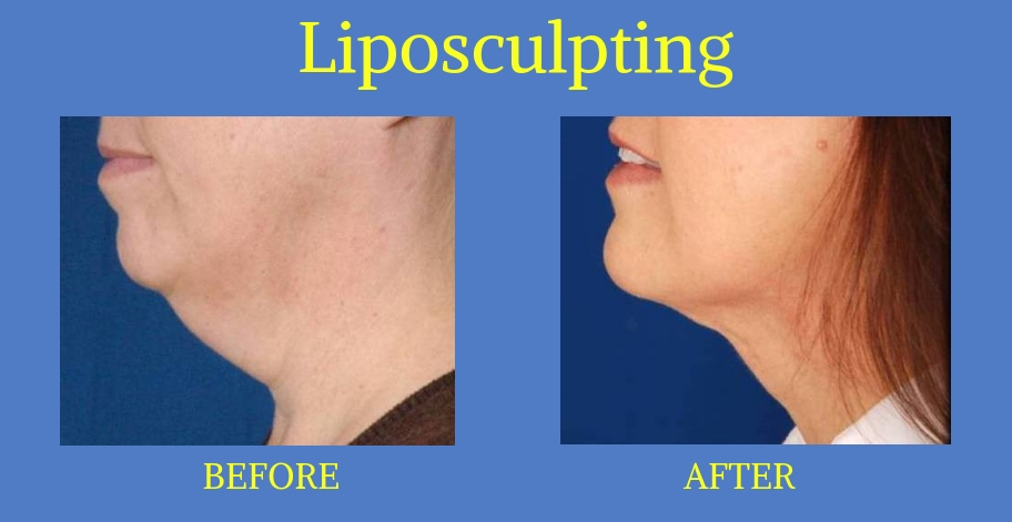 Liposculpting-3-Blog-BA