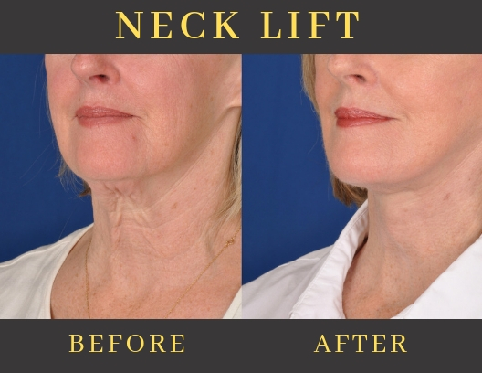 NECK LIFT-img-blog