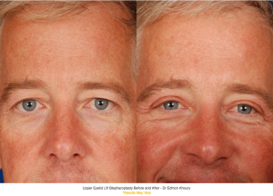 Upper Eyelid Lift Before and After