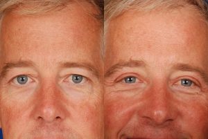 Upper-Eyelid-Lift-Blepharoplasty-Before-and-After-Dr-Khoury-102