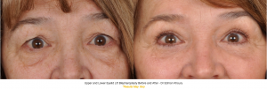 Upper and Lower Eyelid Lift Before and After