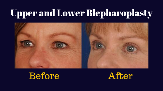 Results of a lower blepharoplasty performed by Dr. KLhoury in Denver