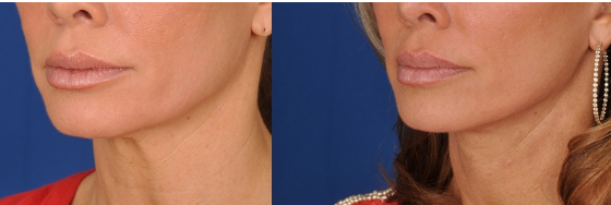 Facelift Before and After