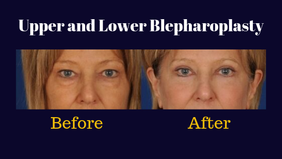 Before and after results of a blepharoplasty performed in Denver